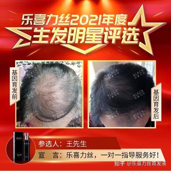 但使用乐喜力丝之后,头发一天天变好,发量增多了,头皮被遮住了,形象
