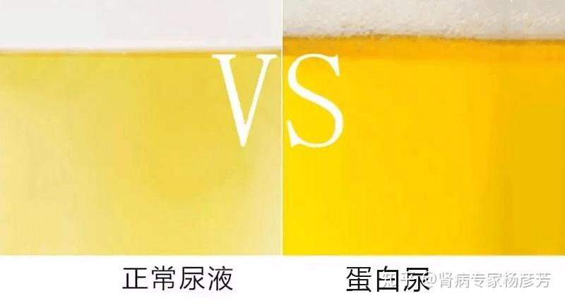 正常人的尿液中也会有少量蛋白质,但是如果尿中蛋白质增多就是典型的