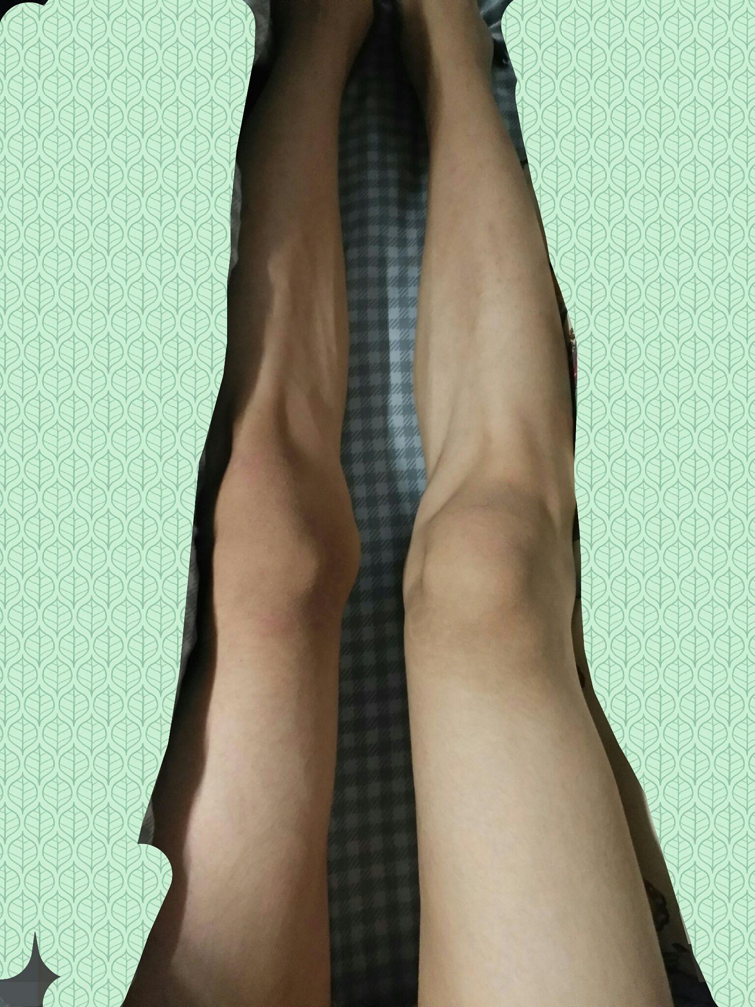 膝盖中间向内侧突出有没有办法让腿变直