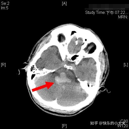 35岁就脑干出血抢救4小时无果让家人情何以堪