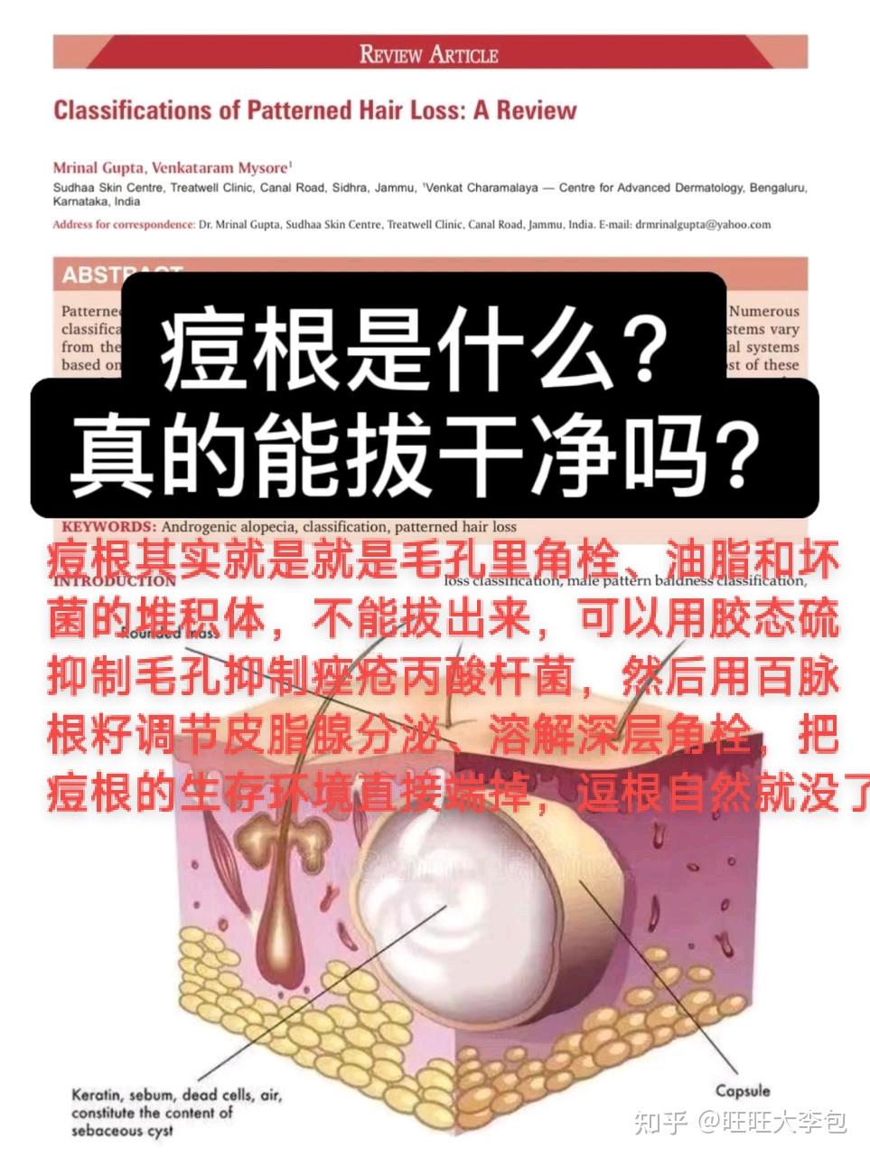 用针把痘痘弄破,会好吗? - 知乎