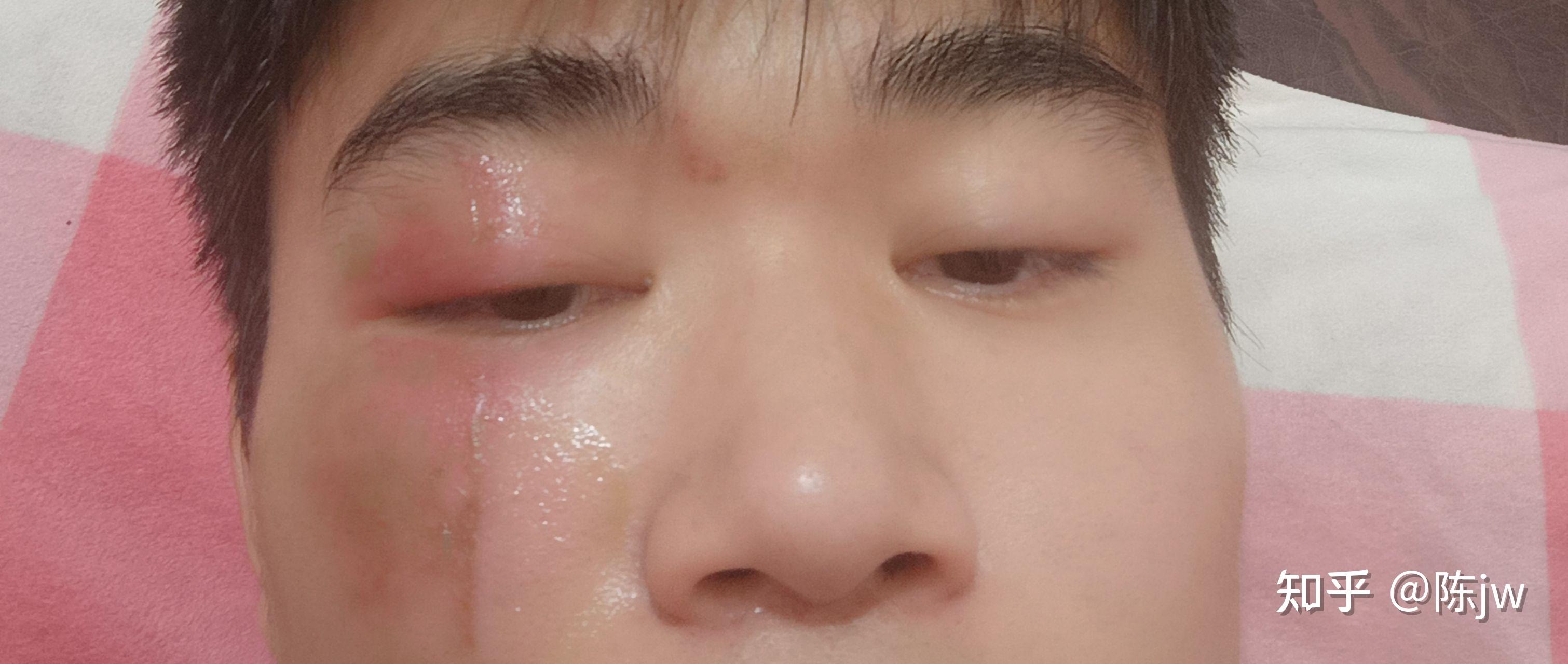 记一次脸部隐翅虫皮炎