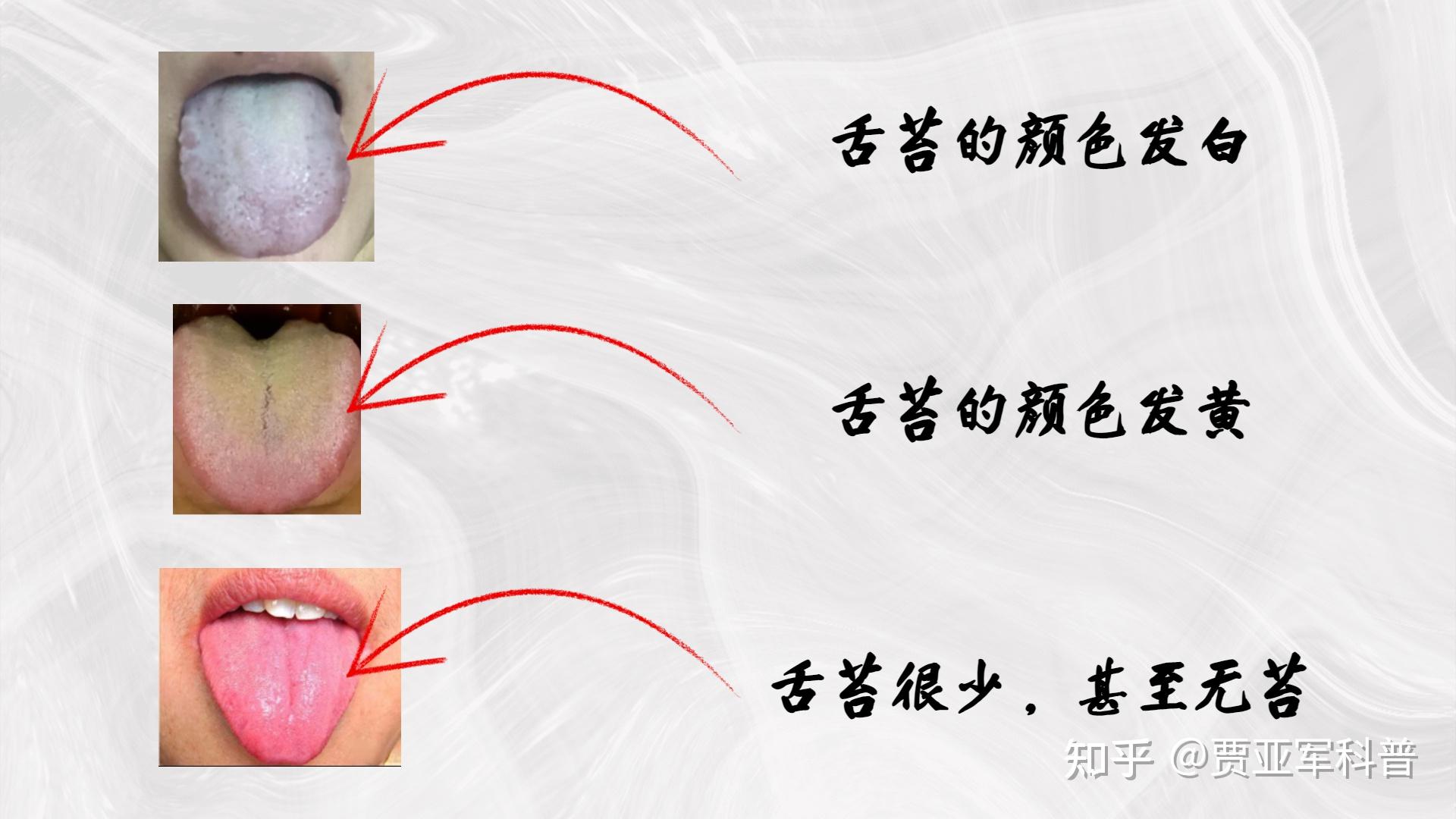 如何从舌苔上看出病情的进程?薄厚苔、润燥苔、腻腐苔如何调理? - 知乎
