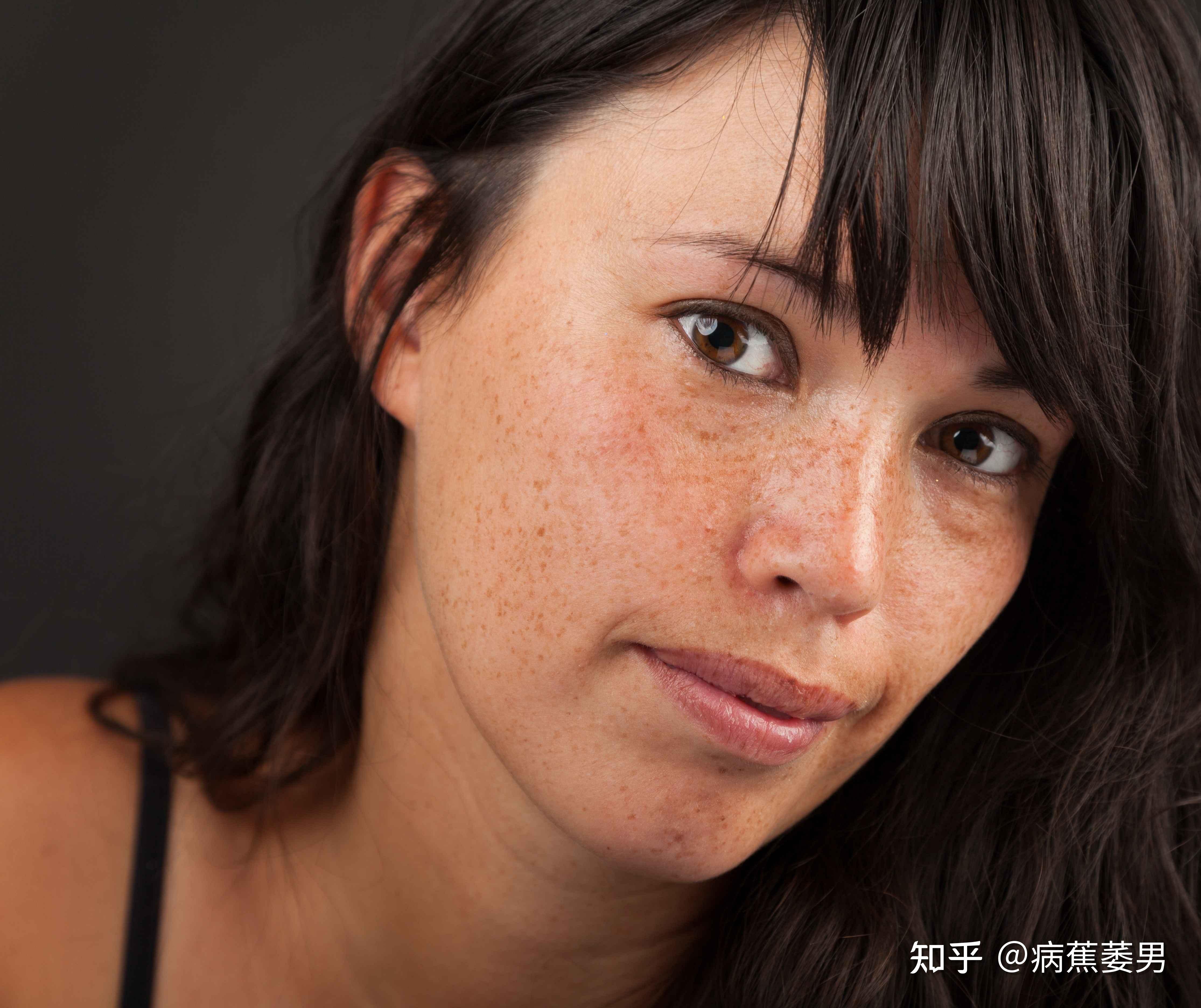 这种症状会导致黄褐斑出现在鼻翼周围,口周以及面颊大部分都是黄褐色