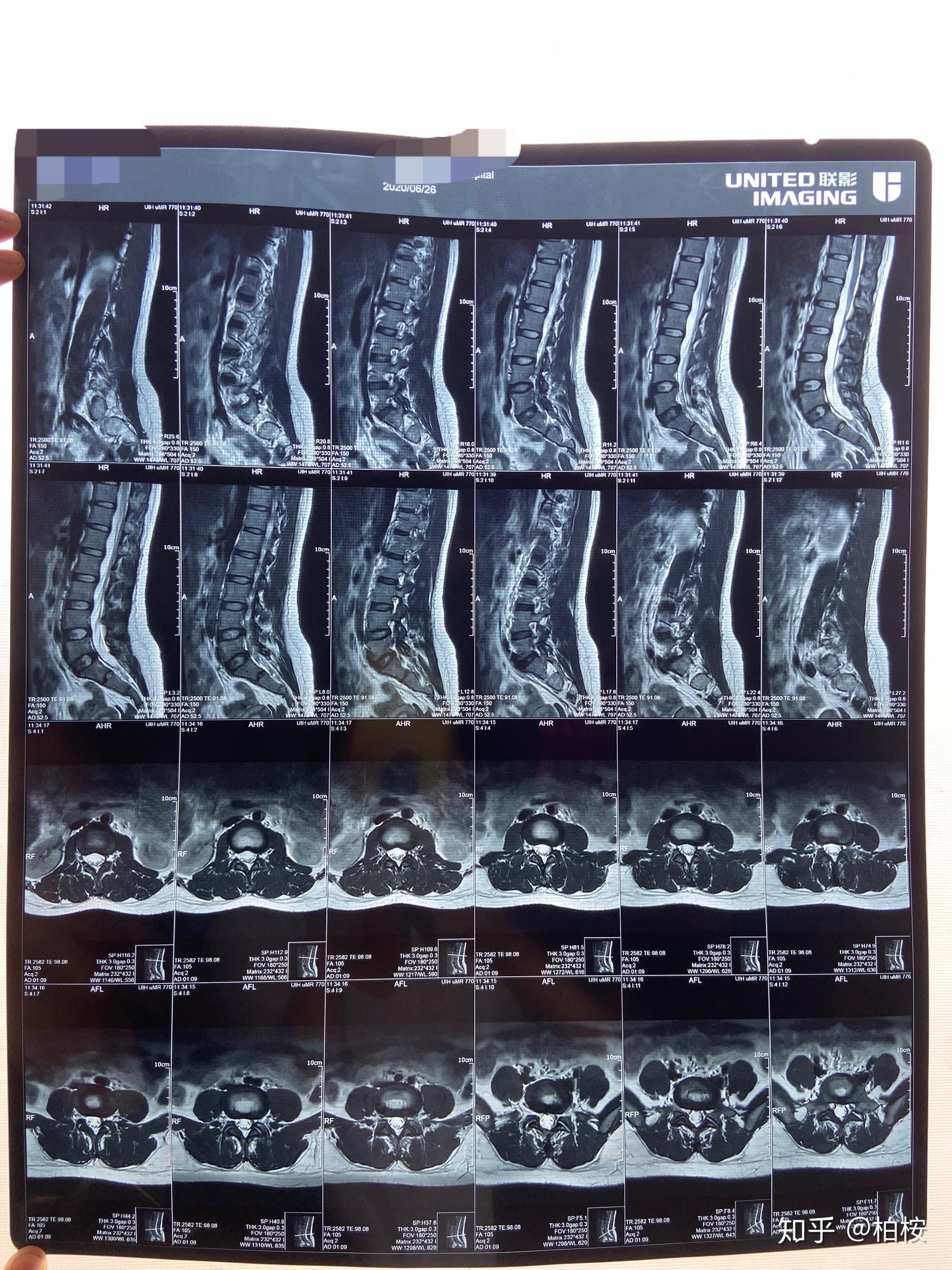 椎弓峡部CT图片