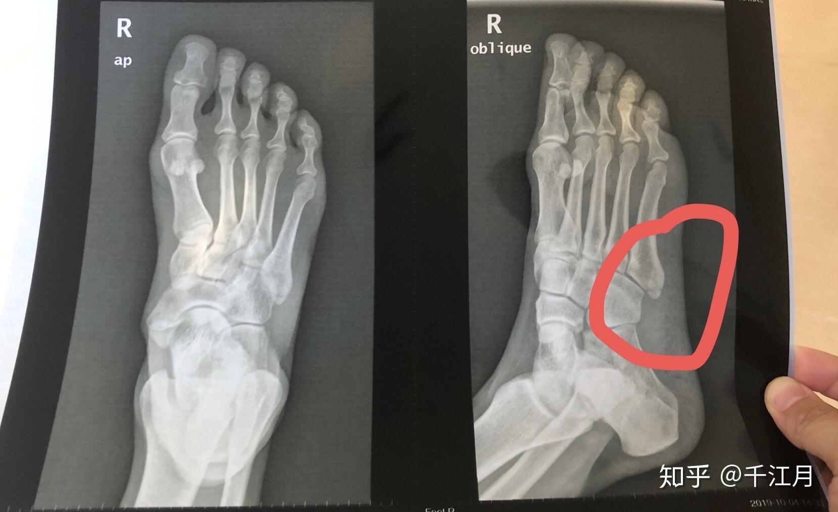 一例右足第2、3、4跖骨骨折的治疗方法 - 病例中心(诊疗助手) - 爱爱医医学网