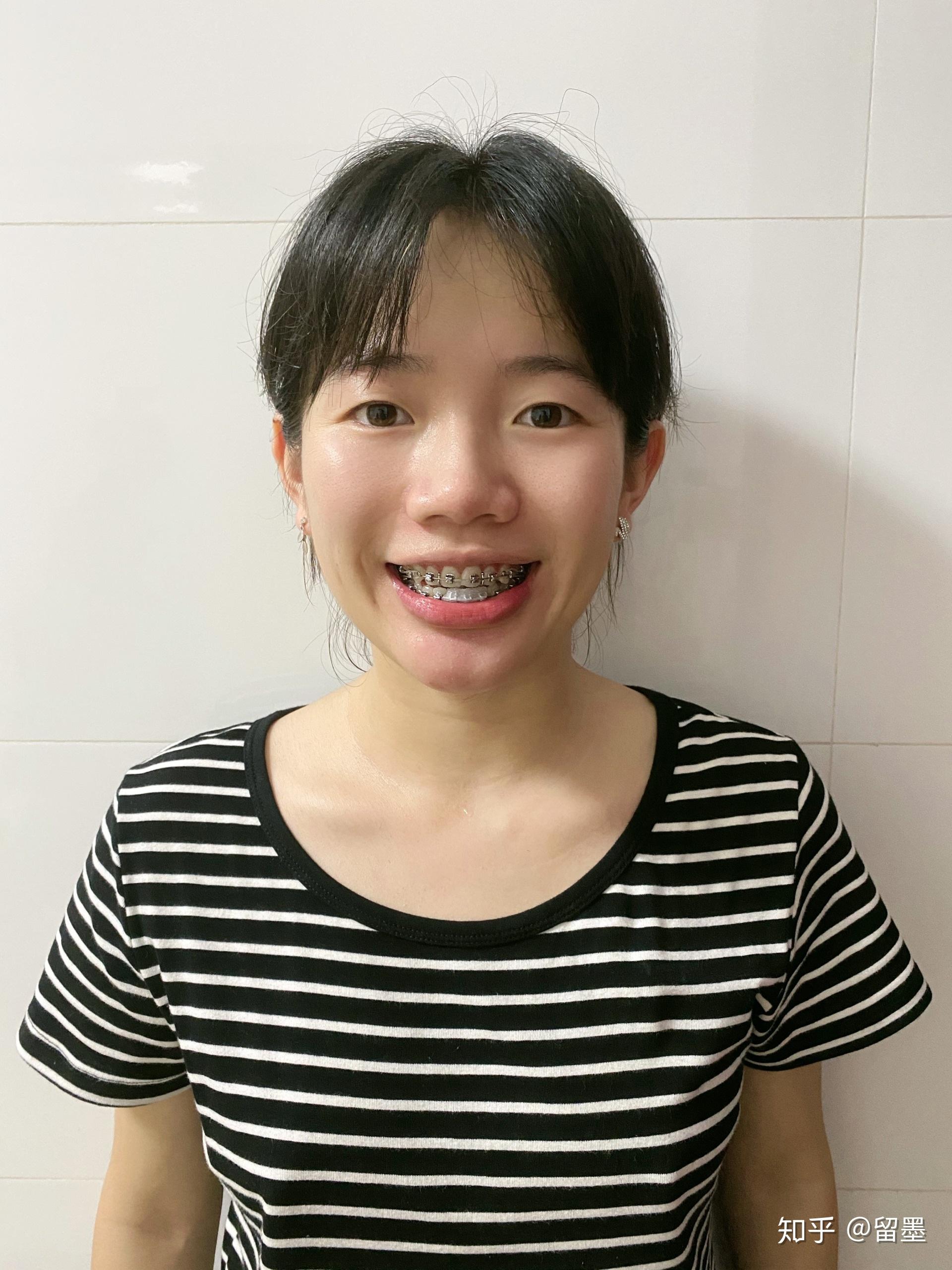 24岁深漂女青年箍牙全记录