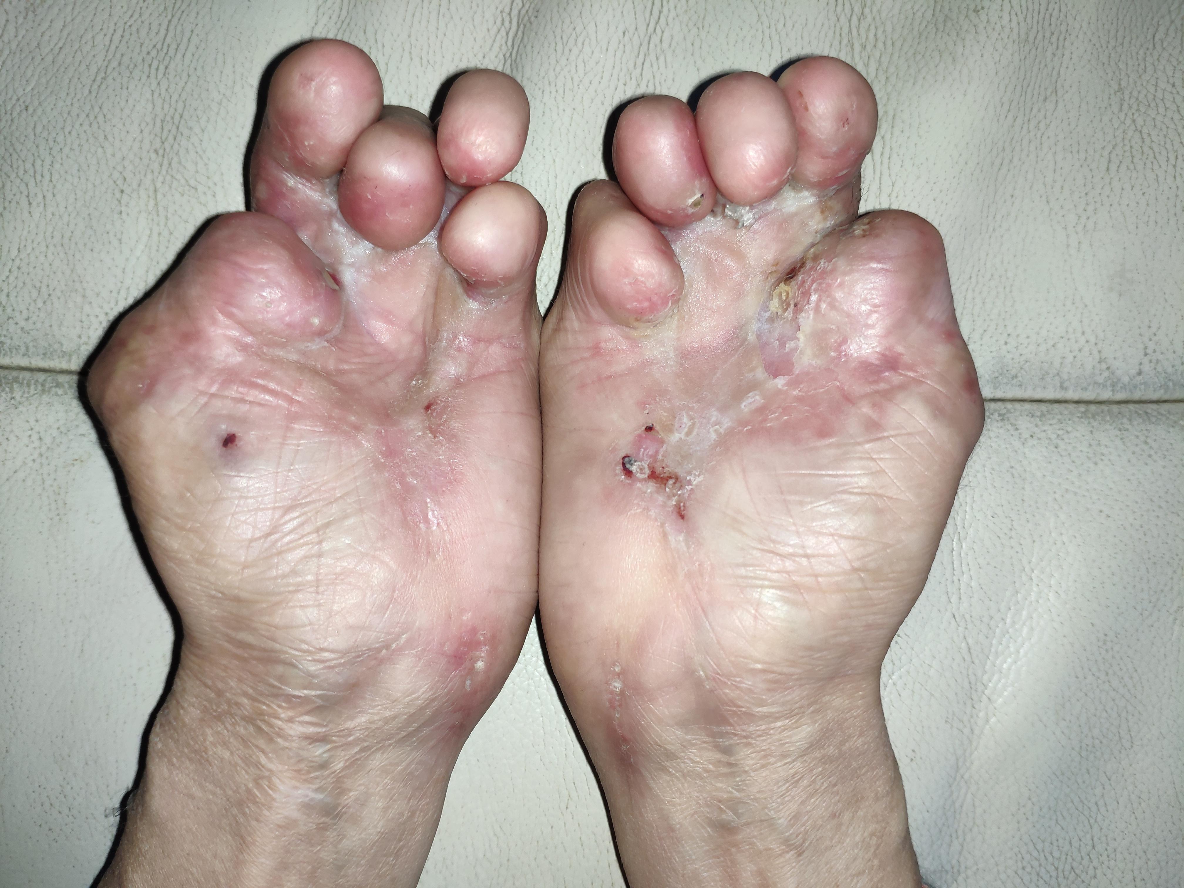 我是一个残疾人我从不避讳这一点写在国际罕见病日