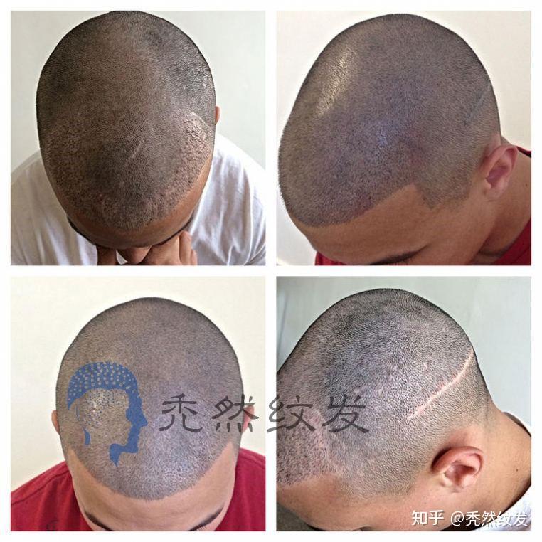 纹发骗局？纹发一年效果图就知道答案！ - 知乎