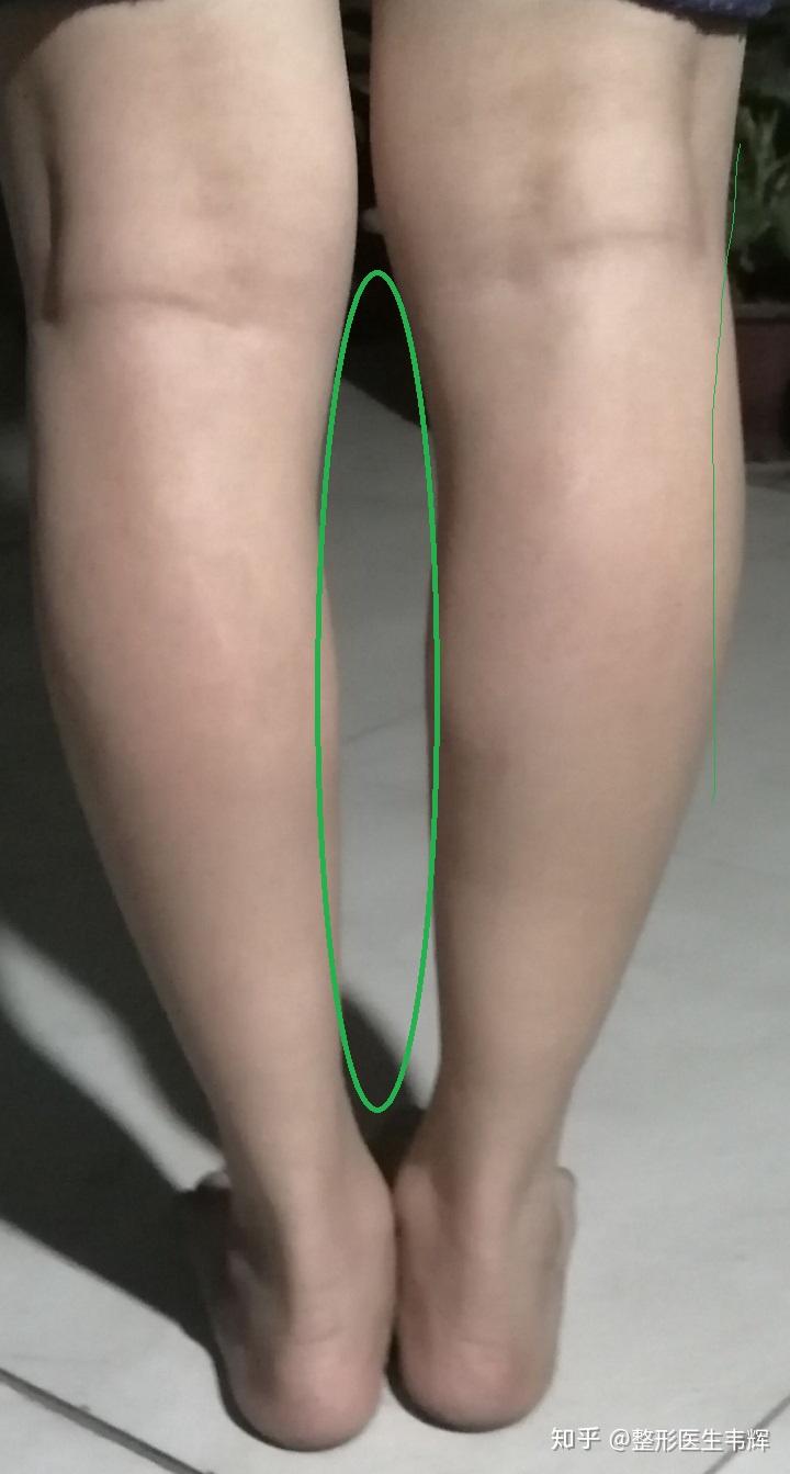 姐妹们这种肌肉腿怎么瘦啊我是不是小腿外翻