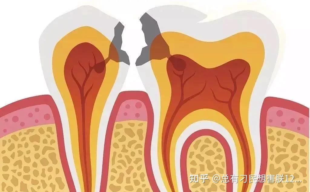 小心邻面龋!一颗坏成俩! - 知乎