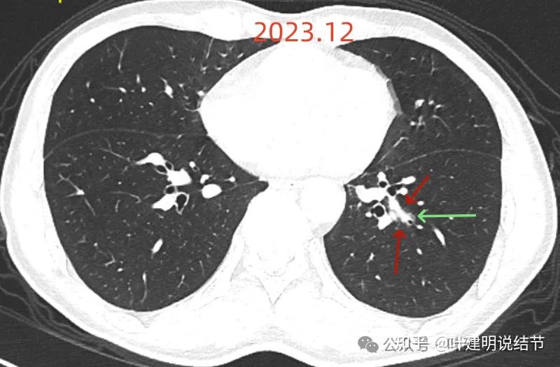 问诊分析(2025.9.30):这个考虑痰栓的肺实性结节会不会其实是鳞癌? - 知乎
