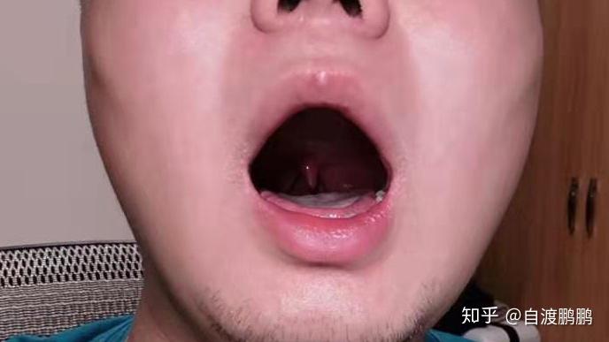 多数说话大舌头的人存在舌头后半部分隆起的情况,可通过吞咽动作