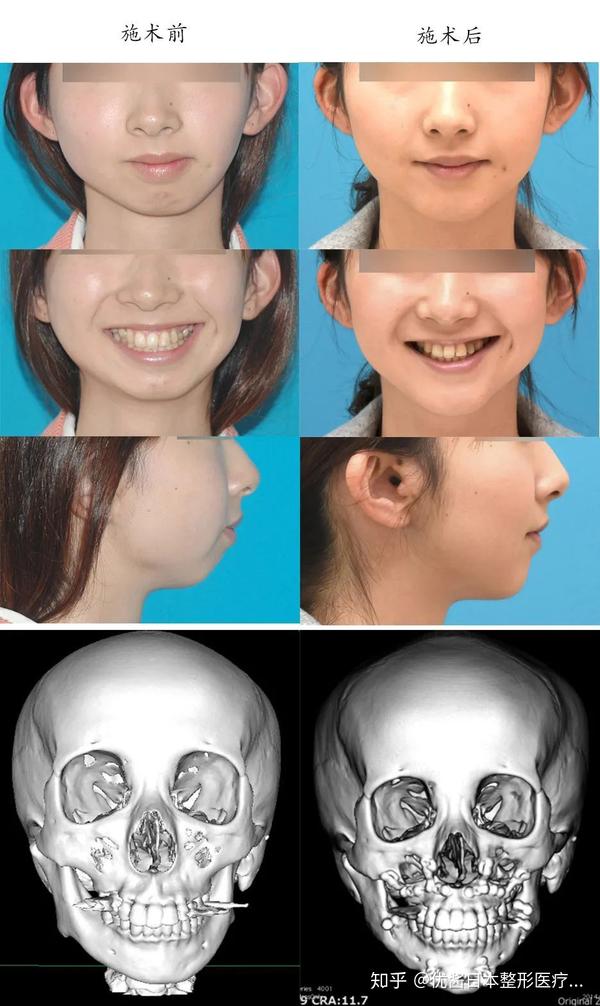 优酱名医图鉴 专攻轮廓手术的颜面骨大师 宇田宏一 知乎