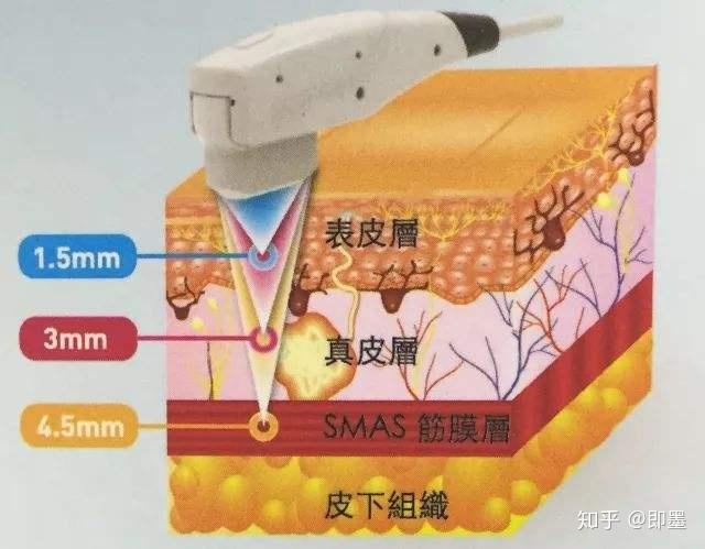 超声刀的副作用会有哪些做了超声刀后悔了