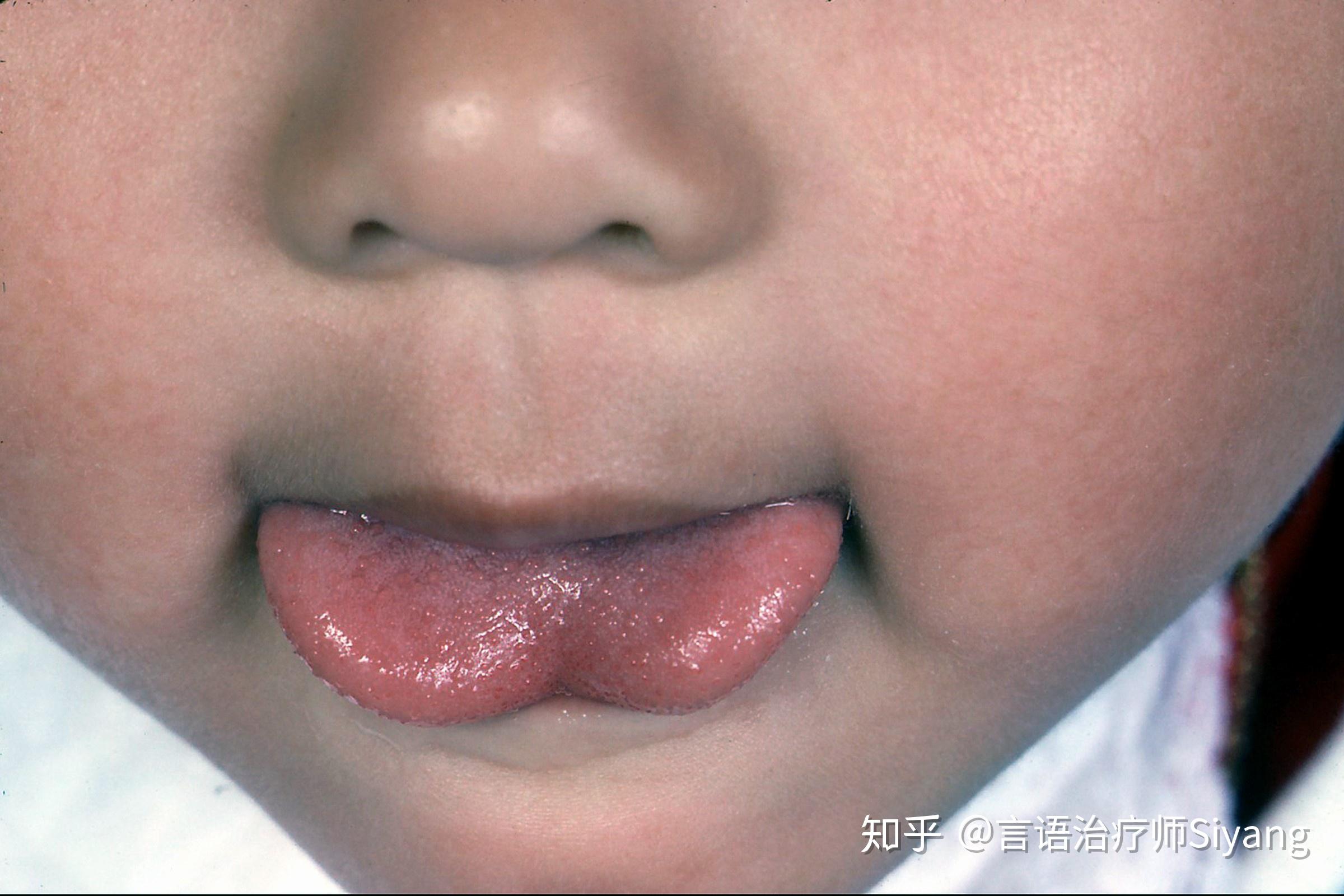 宝宝舌苔上的四种疾病信号，你看懂了吗？
