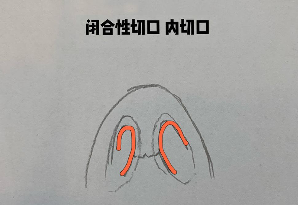 隆鼻手术切口是什么样的?可以自己选择吗? - 知乎