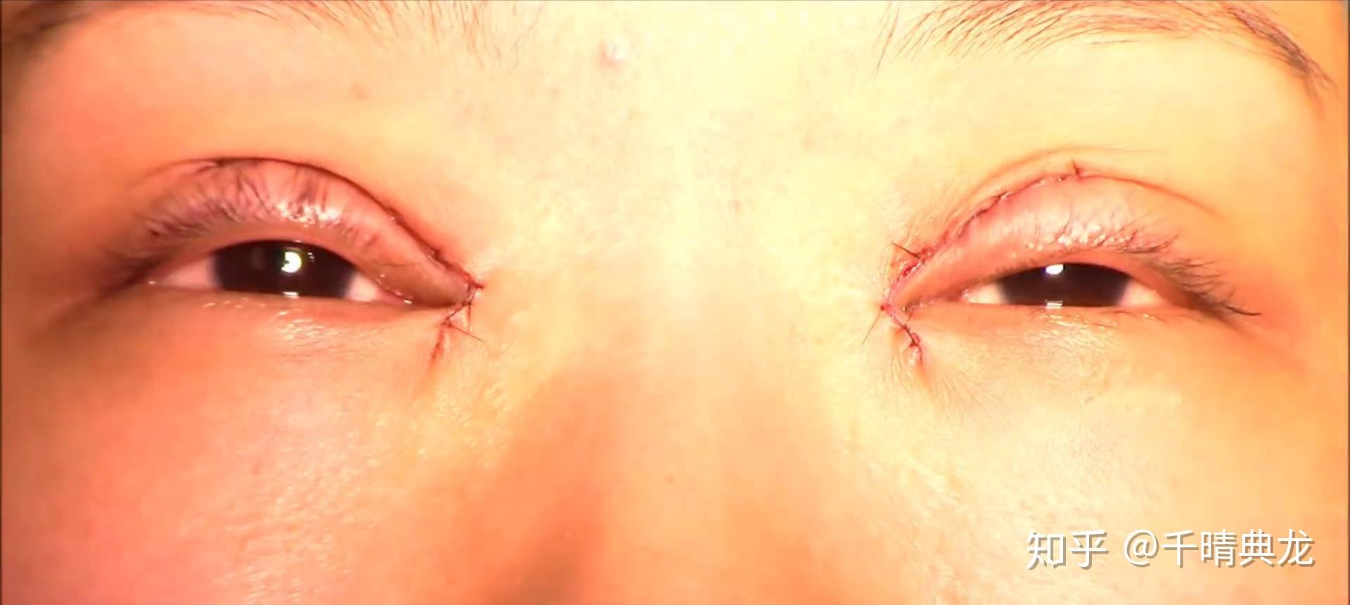 千晴王子丨全切式双眼皮的整个手术过程到底是怎么进行的呢