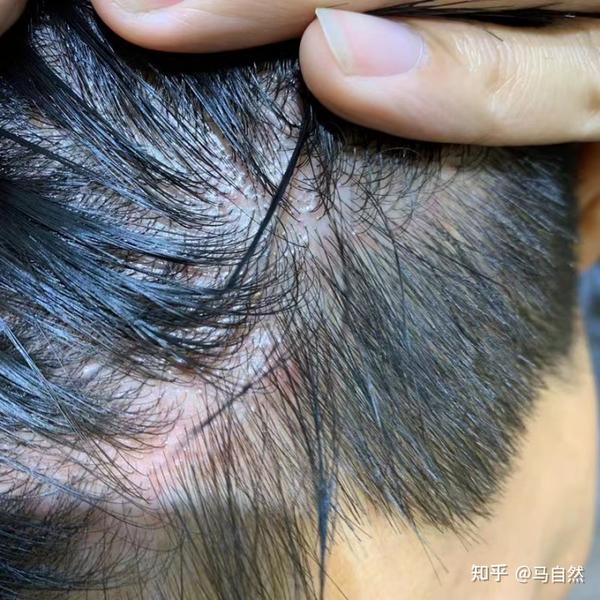 为什么头皮总是搔痒，皮肤科医生告诉你真相，帮你解决头痒问题