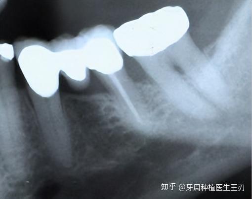 如何治疗牙周根分歧病变 - 知乎