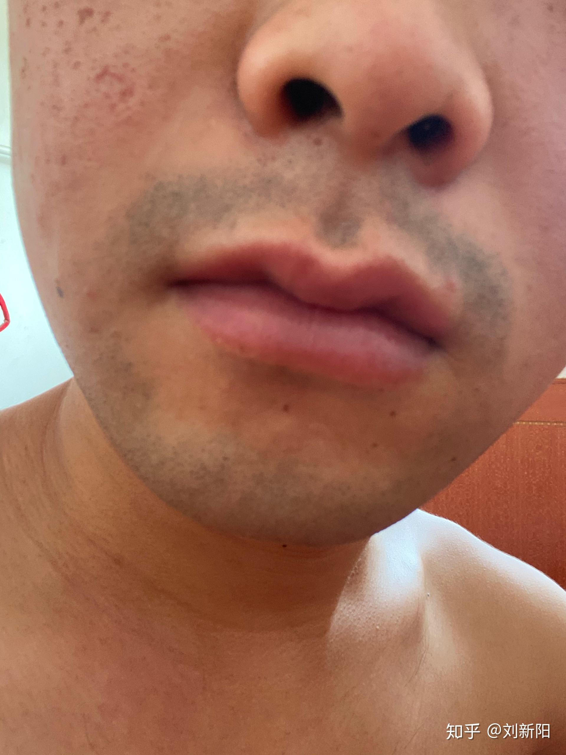 刮胡子造成的黑色素沉淀点阵激光可以去除吗