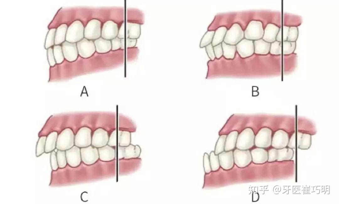 6,以下哪个是安氏三类错颌畸形?