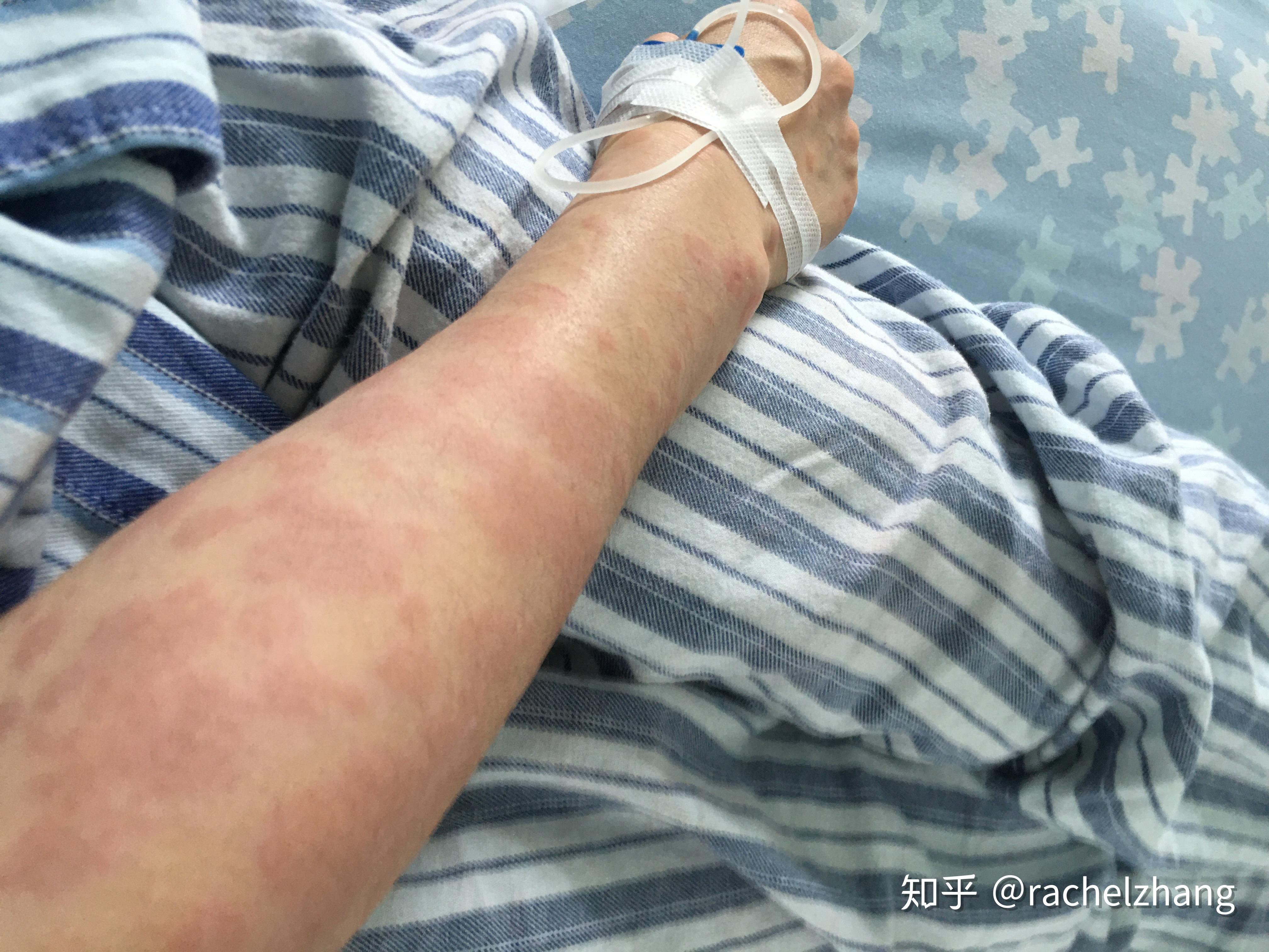 松花粉真有那么好刚经历过药物过敏的人来告诉你