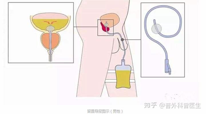 通过皮肤穿刺进入膀胱,将膀胱里面的尿液引流出来,或者使用注射器将