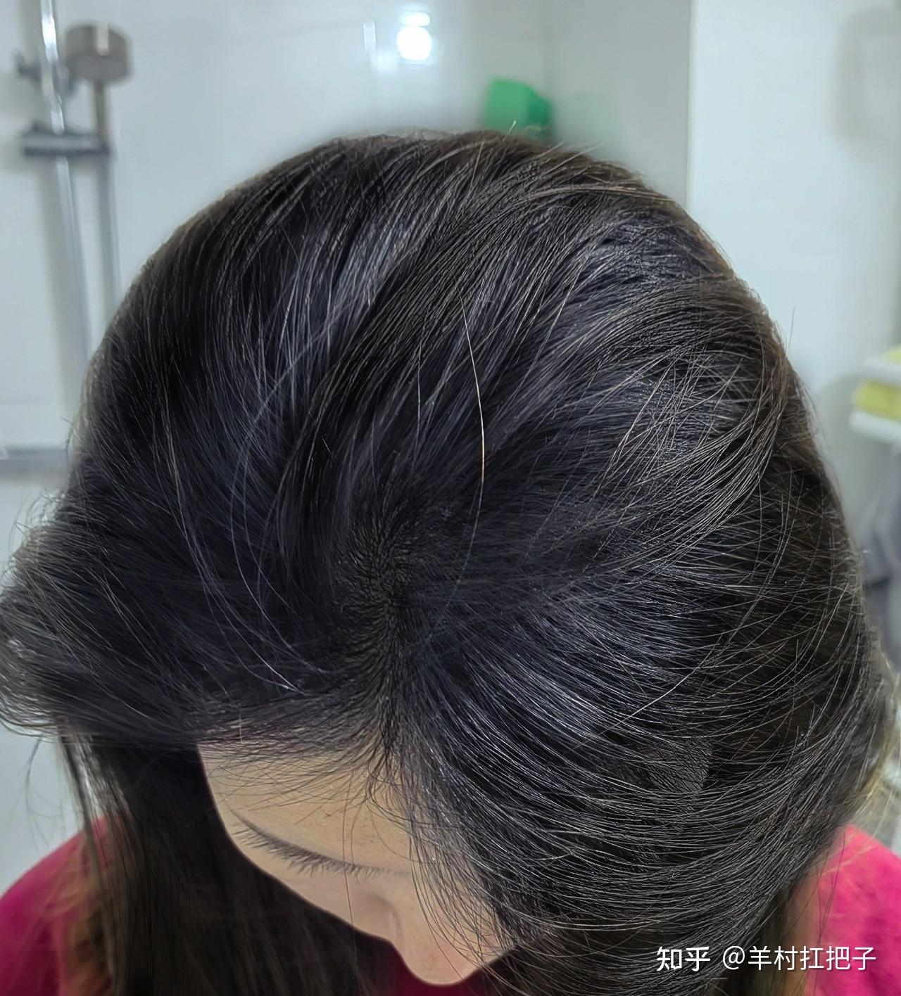 与少白头和解的第四个月,我终于不用染头盖白发了,无偿分享如何解决少白头! - 知乎