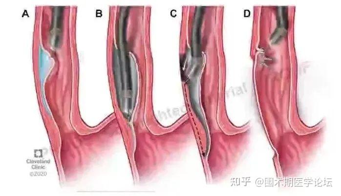 病例分享丨寻踪觅迹，揭示POEM术中气道峰压“异常”增高的真相 - 知乎