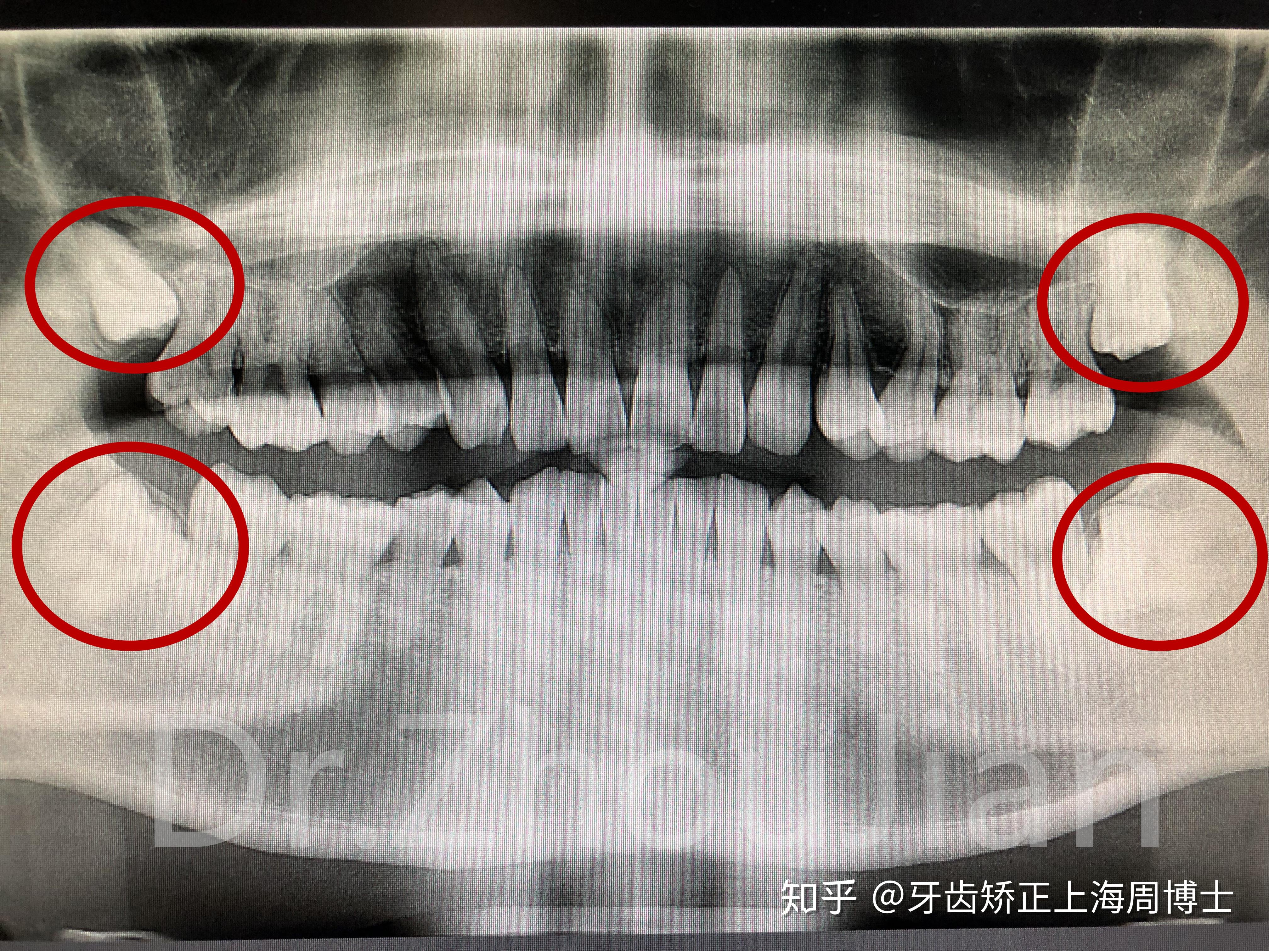 拔智齿后，你吃什么？愈合过程记录？ - 知乎