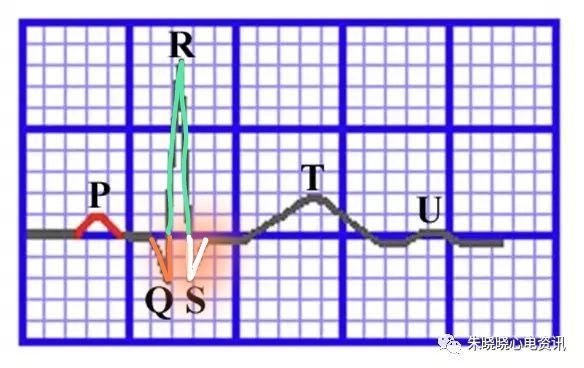 心电图qrs波图解图片