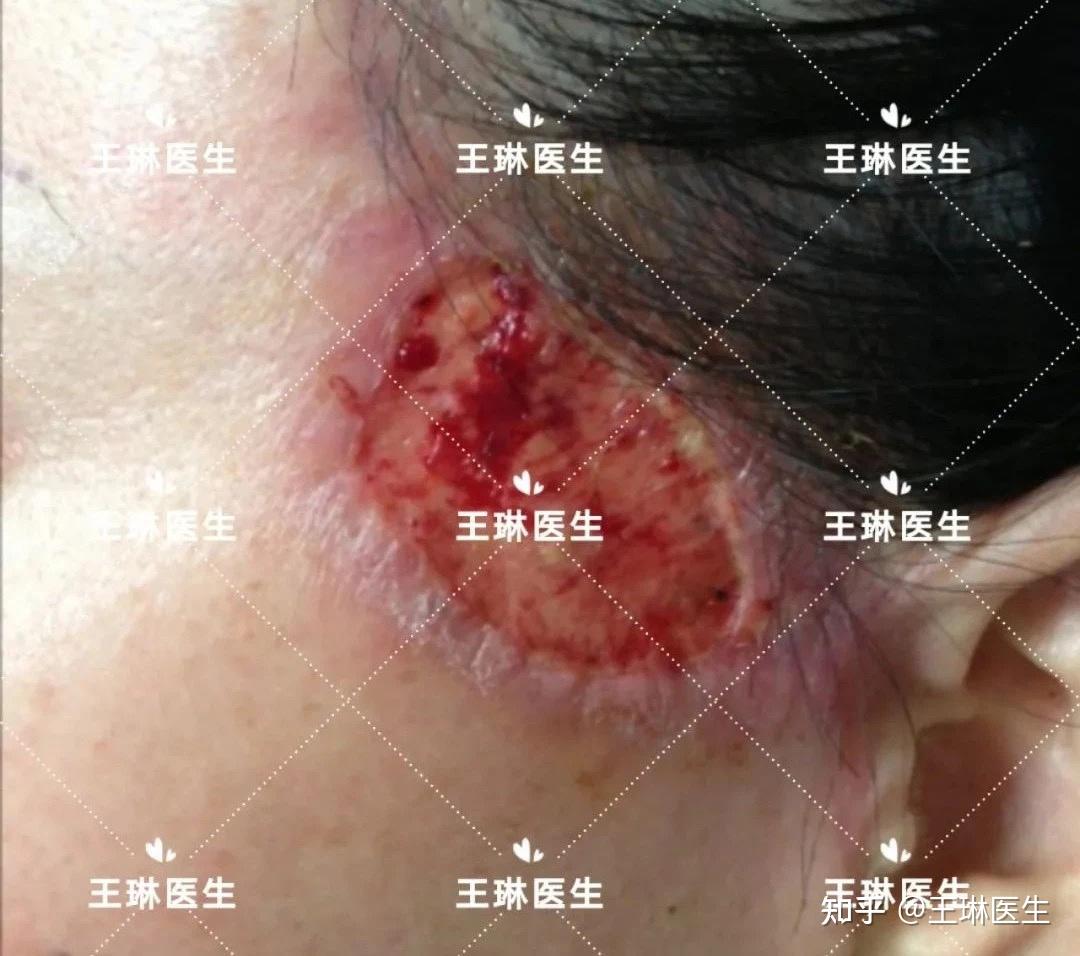 面部填充手术3d演示_面部填充术_面部填充手术风险大吗