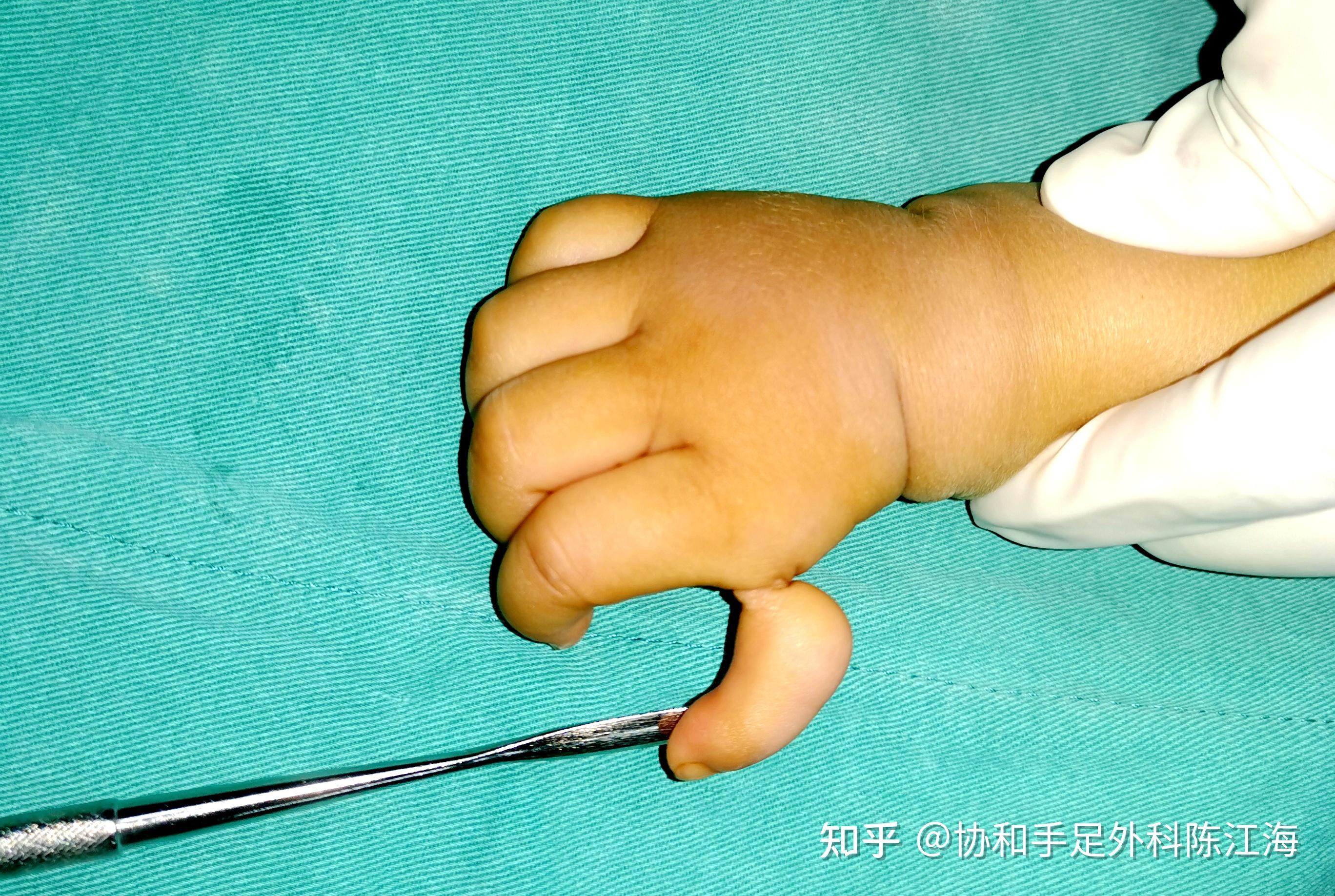 “手指上的艺术”，并指畸形矫正|软组织|矫正|手指|指骨|肌腱|皮肤|先天性并指畸形|-健康界