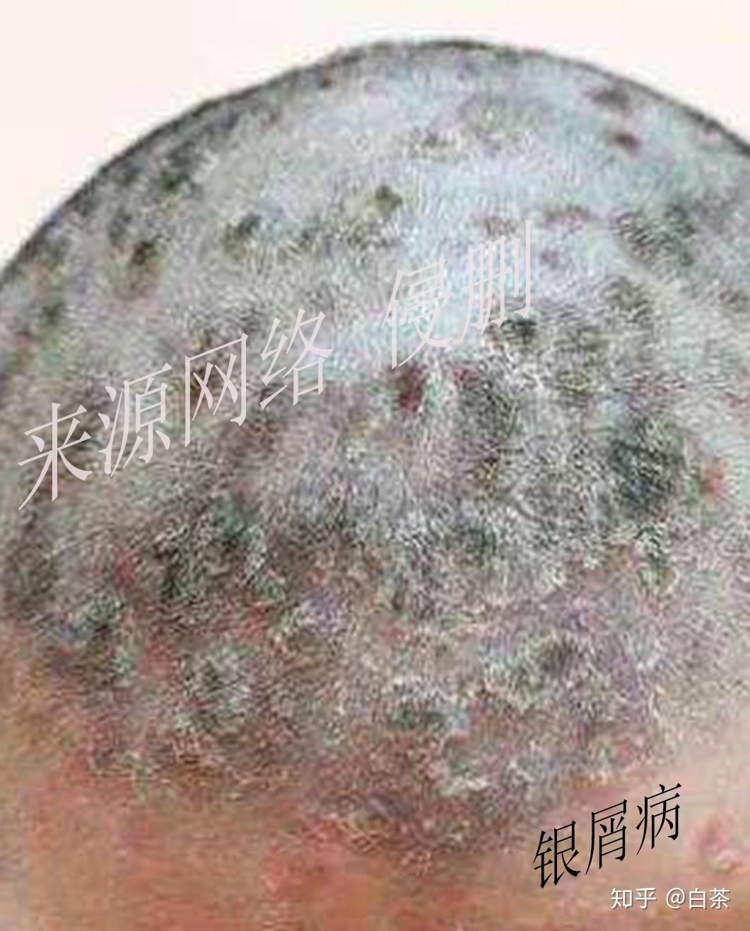 请问得了头部脂溢性皮炎 经常扣那些小疙瘩会怎么样....? - 知乎