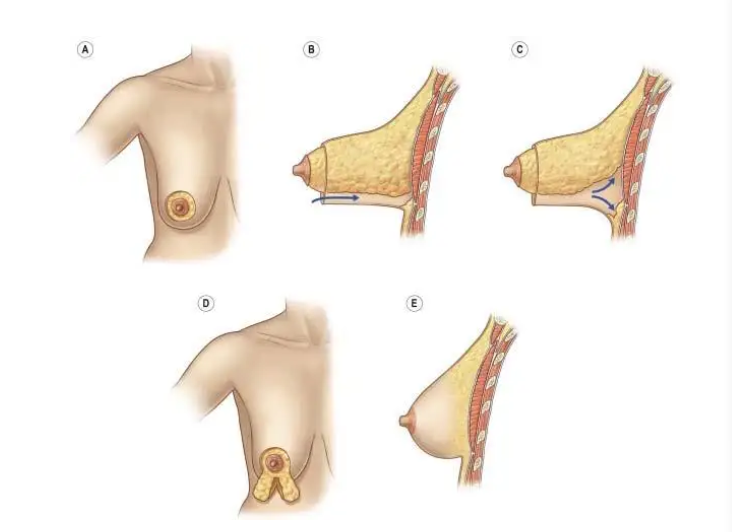 乳房悬吊术是怎么回事? 