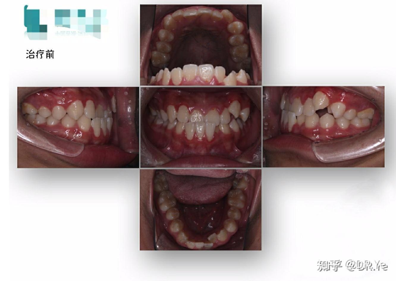 其中骨性还分为 a上颌发育不足 b下颌发育过度 c两者兼有三种.