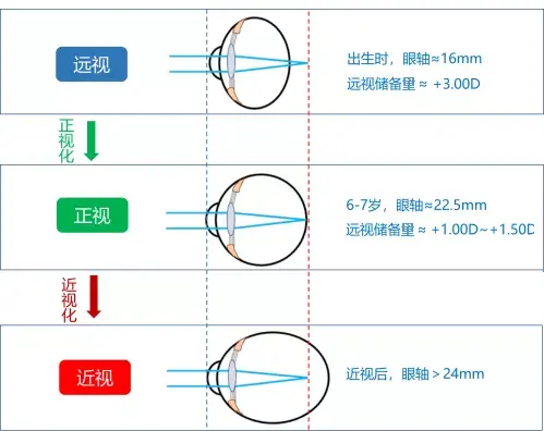 宝宝刚出生时眼球较小,眼轴较短,此时双眼处于生理性远视状态.