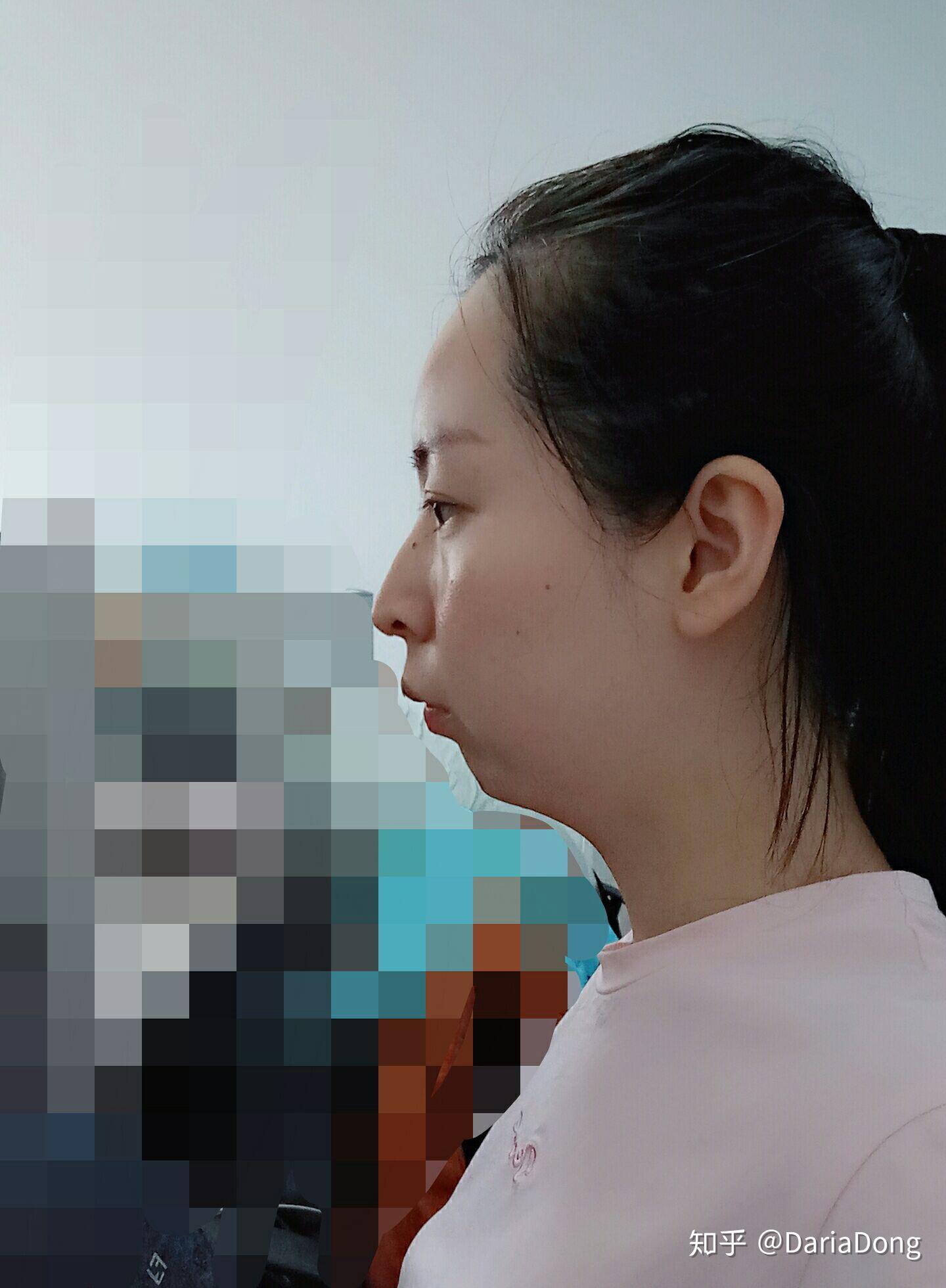 口呼吸面容成年后可以矫正吗