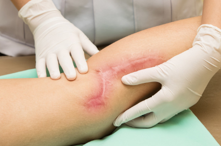 伤口愈合的四个阶段