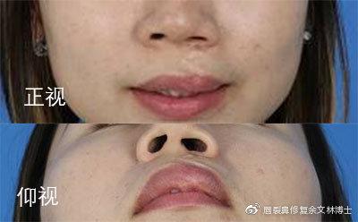 27岁才做唇裂修复二期手术会不会太晚? - 知乎