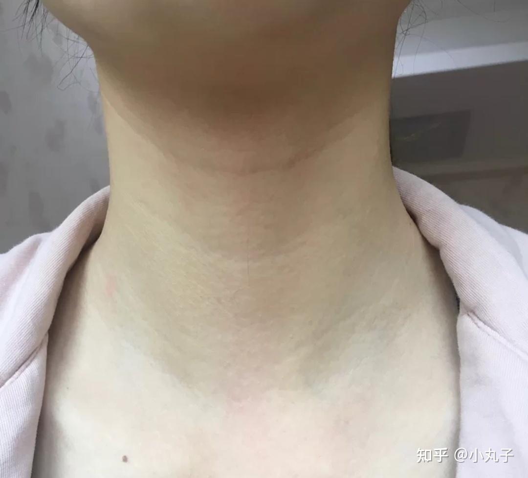 如今韩国可以通过颈纹手术来消灭颈纹 - 知乎