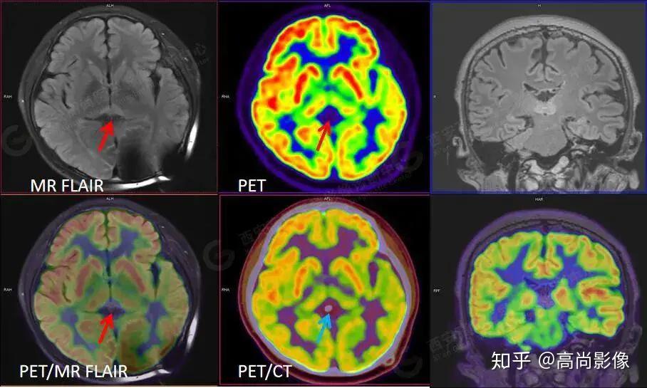 西安高尚医学影像petctmr多模态显像病例集锦第一期