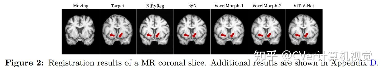 ViT-V-Net：无监督Volumetric医学图像配准的视觉Transformer - 知乎