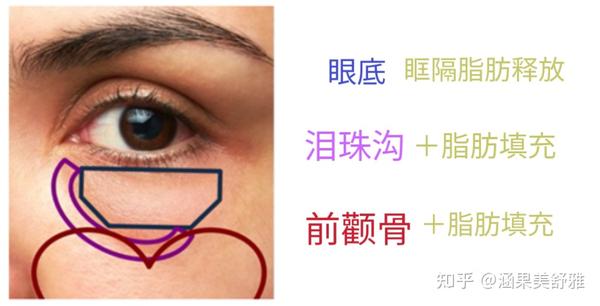 做眶隔脂肪释放手术 来年轻10年的方法！ - 知乎