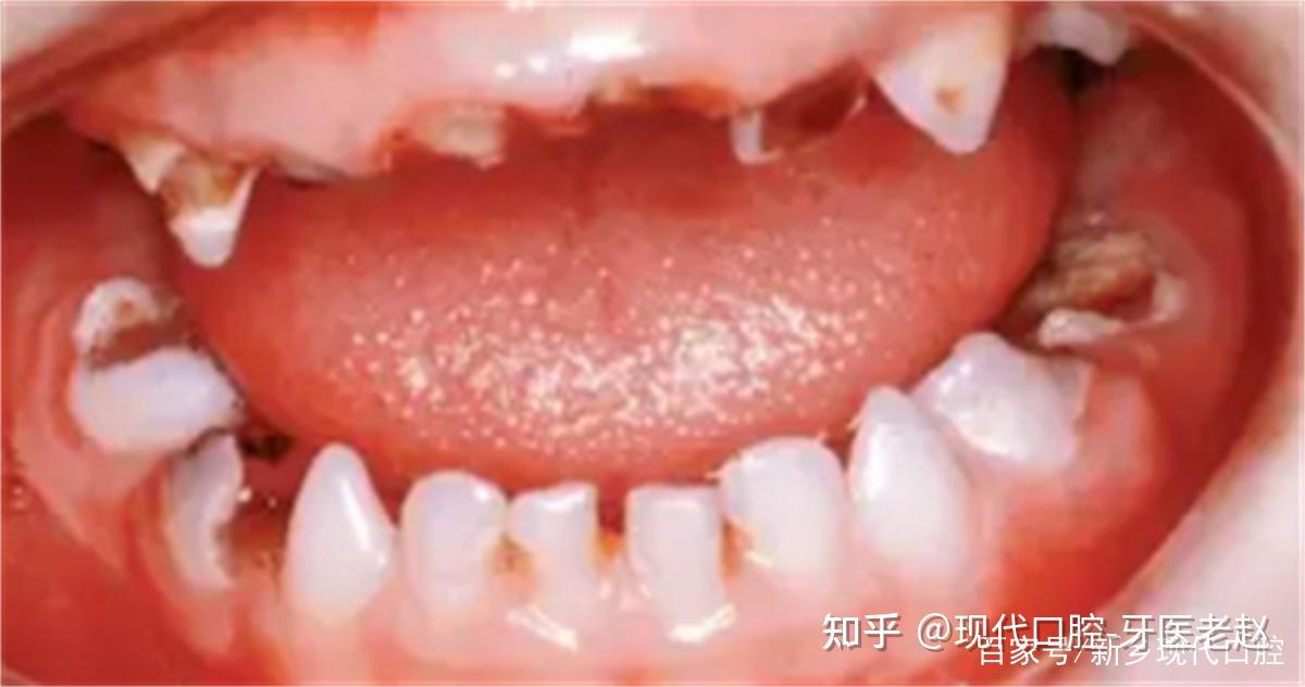 残冠,残根要不要拔除 - 知乎