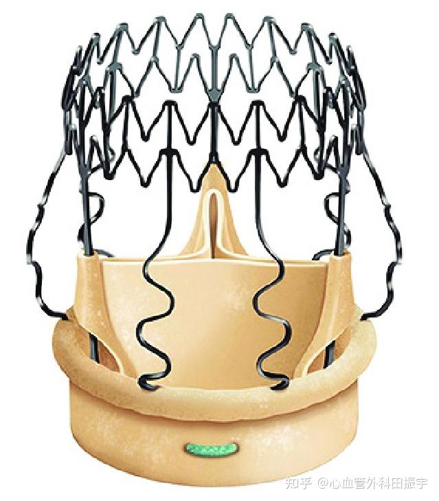 免缝合主动脉生物瓣