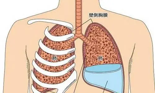 晚期肺癌患者的胸水腹水是什麼該怎麼應對