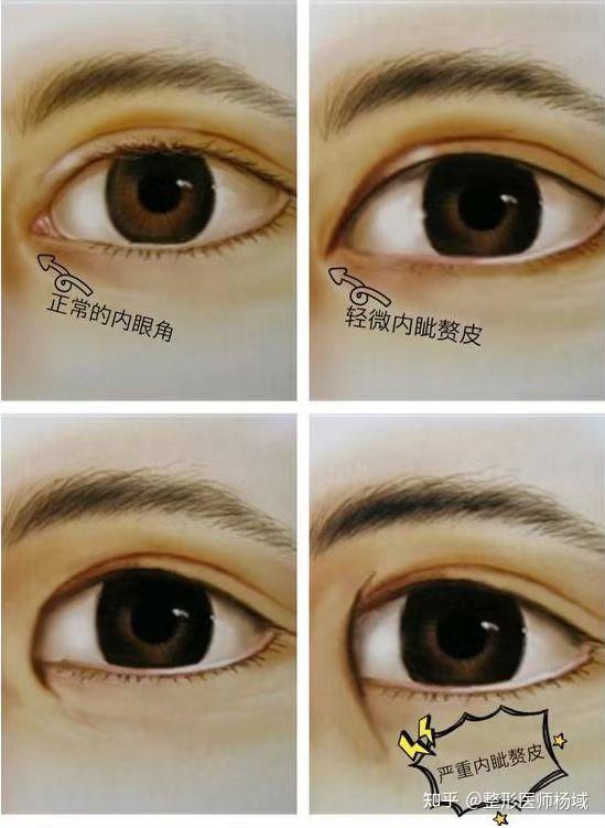 今日科普下什么是内眦赘皮,也就是俗话说的内眼角 - 知乎