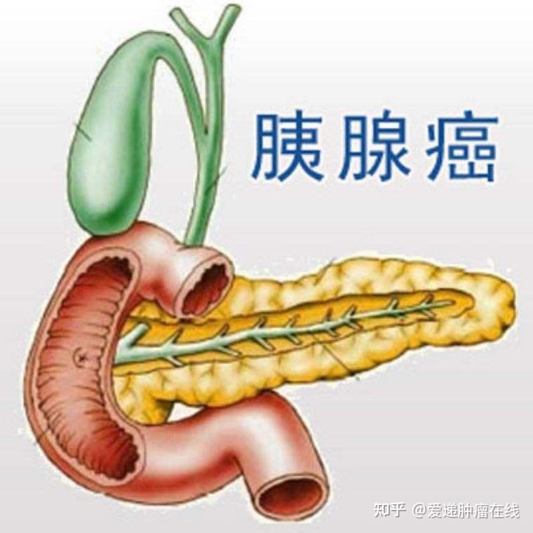 胰腺癌的临床表现! - 知乎